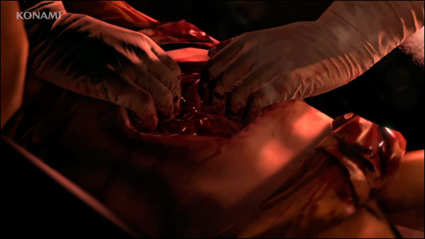 MGSV-E3-Trailer-Stomach-Surgery
